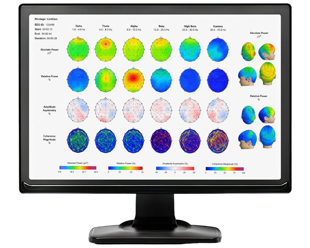 A sample brain mapping report for ADHD diagnosis.